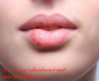 Both are reactivations of an oral herpes infection. 7 Home Remedies for Fever Blisters That Work Like a Charm!