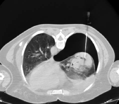 Pneumothorax On The Ct Scan Performed During The Transthoracic Needle