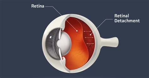Retinal Detachment Causes Symptoms And Treatment