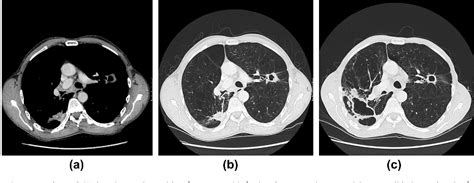 Figure 1 From The Development Of Pulmonary Aspergillosis And Its