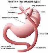 Photos of Long Term Side Effects Gastric Bypass Surgery