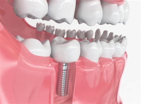 What Are The Different Types Of Dental Implants Vrogue Co