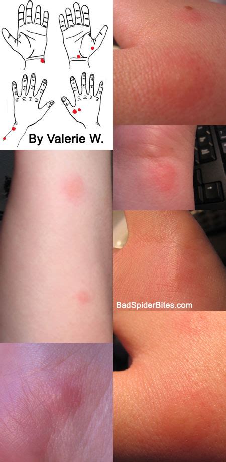 Bed Bug Bite Pictures On Hands Bed Bugs Bkzb