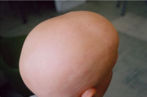 Alopecia Concise Medical Knowledge