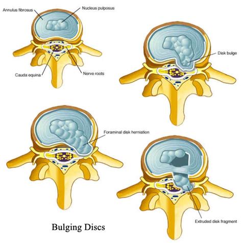 I have three bulging discs in my neck that cause me severe pain in my right arm, weakness in the arm, and numbness in the hand. Bulging Disc in Neck | Painful Spine Conditions in the Neck