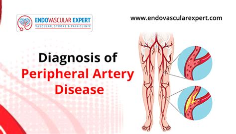 Diagnosis Of Peripheral Artery Disease Endovascularexpert