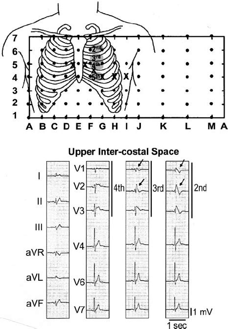 Shift Of Right Precordial Leads To 2nd And 3rd Intercostal Spaces