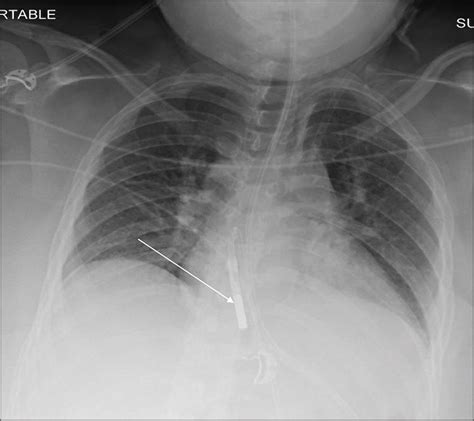Malpositioned Lines And Tubes On Chest Radiograph A Concise Pictorial Review Journal Of