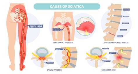 Sciatica Causes Conservative Care Surgery And Injection Treatments Joint Rehab And Sports