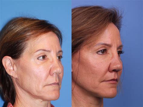 Facelift Before And After Pictures Case 213 Scottsdale Az Hobgood Facial Plastic Surgery