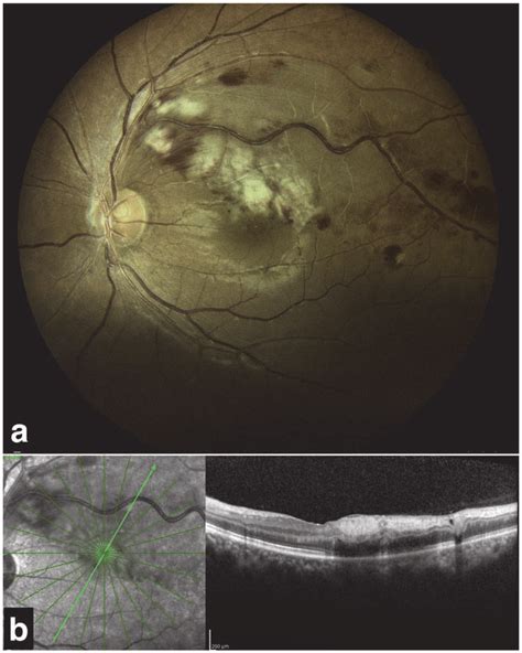 A Fundus Photograph Showing Brvo With Branch Retinal Artery Occlusion