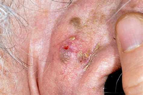 Squamous Cell Carcinoma Skin Disorders