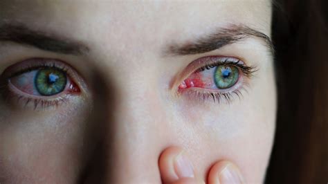 Dry Eyes Red Eyes And Allergies Dr Bradley Doolen Optometric Physician