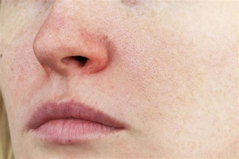 Acne Rosacea What It Is Comparison To Acne Symptoms And Treatments
