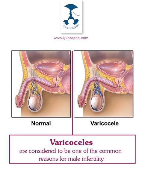 Varicocele In 2020 Male Infertility Treatment Infertility Infertility Treatment