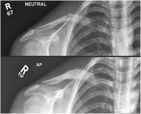 Clavicle Collar Bone Fracture Healthier Together