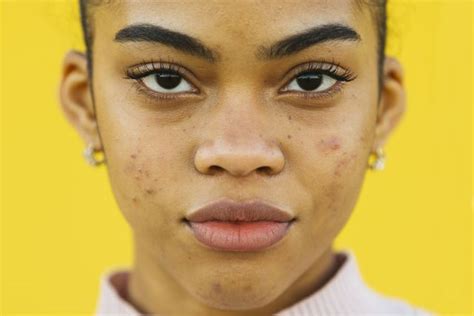 11 Sneaky Causes Of Acne You Might Not Expect