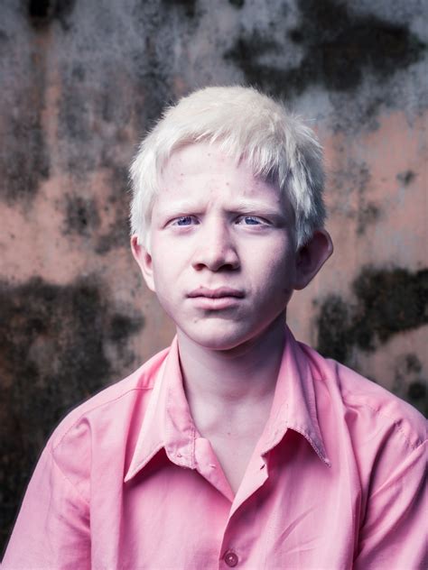 Indian Boys With Albinism Brent Stirton