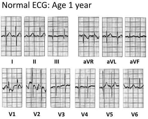 Normal Paediatric Ecg Litfl Ecg Library Diagnosis
