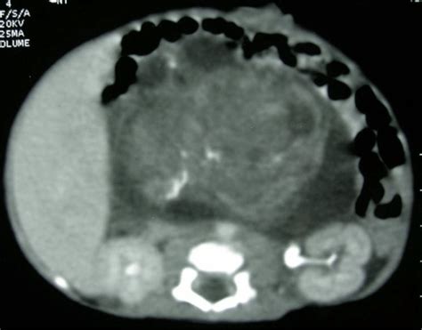 Ct Scan Abdomen Showing A Large Heterogeneous Retroperitoneal Mass With