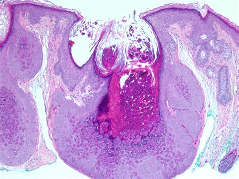 Molluscum Contagiosum HistoCloud