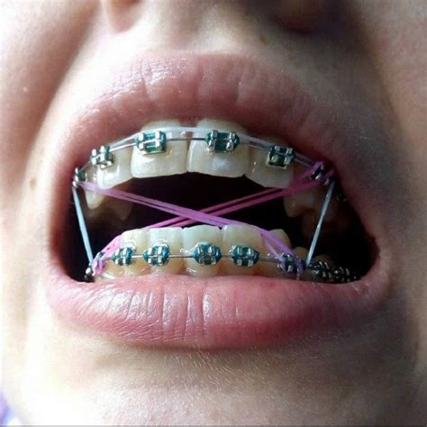 Pin By Shrood Burgos On Braces Dental Braces Braces Girls Cute Braces