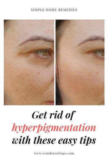 How To Get Rid Of Hyperpigmentation On Lips Hyperpigmentation Occurs