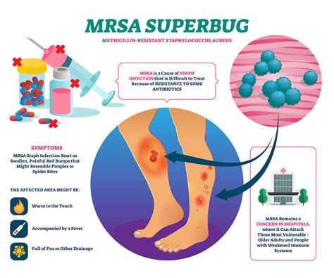 Mrsa Infections In Nursing Homes And Care Living Facilities