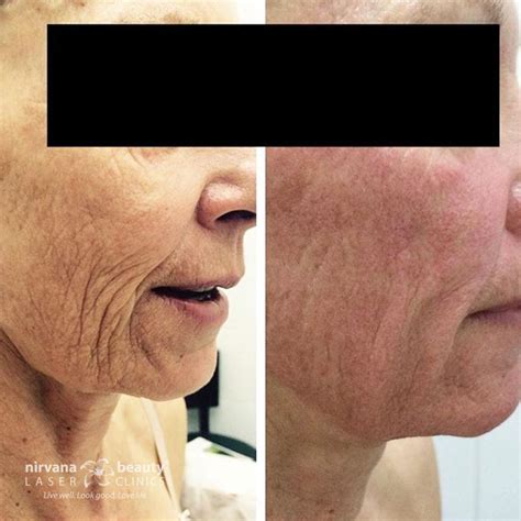 Dermapen Before And Afters Nirvana Beauty Laser Clinics