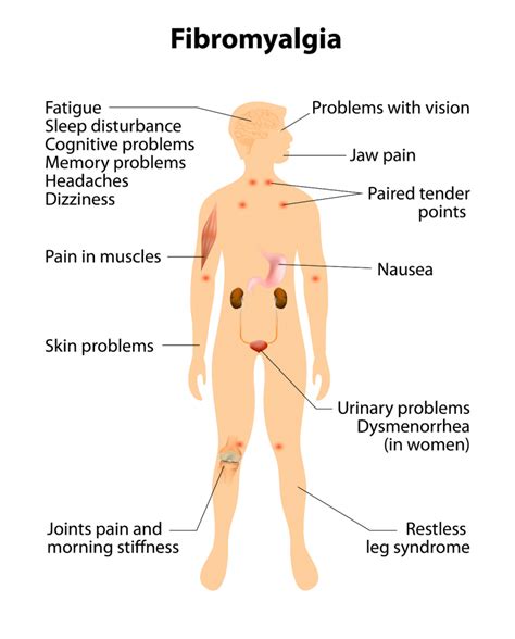 Treatments that work for some people will not necessarily work for others. Fibromyalgie en de voordelen van het gebruik van cannabisolie!