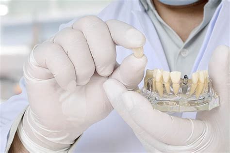 Cuidados Antes Y Despu S De Ponerse Implantes Dentales Cl Nica Dental