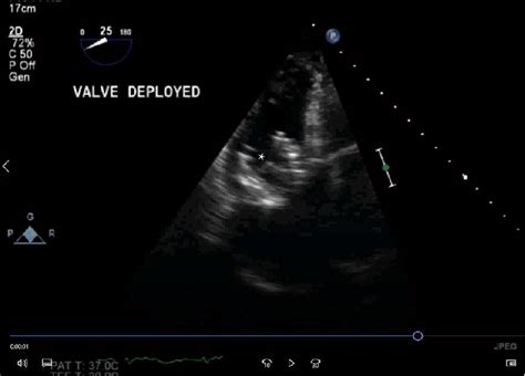 Post Implantation Deep Transgastric View Of The Right Ventricle