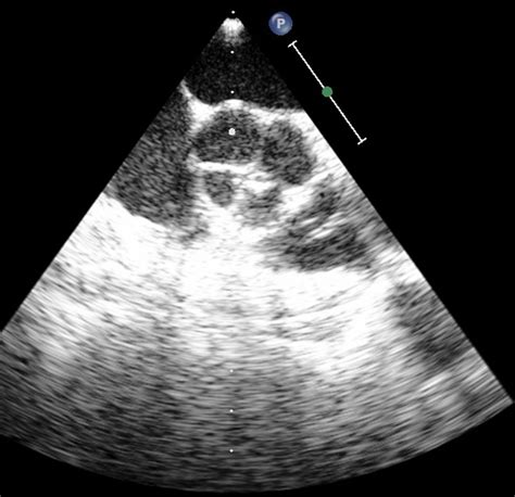 Quadricuspid Aortic Valve A Rare Congenital Cardiac Anomaly Bmj Case