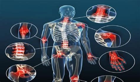 Arthrose und osteoporose sind heilbar! L'arthrose la maladie la plus fréquente