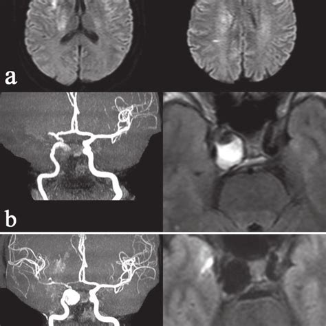 A Initial Right Icag Demonstrates Occlusion Of The Right Mca M1
