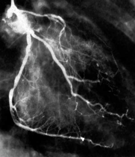 Narrowed Coronary Arteries Photograph By Zephyrscience Photo Library
