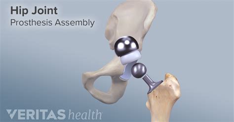 All About Anterior Hip Replacement Hip Replacement Exercises Hip