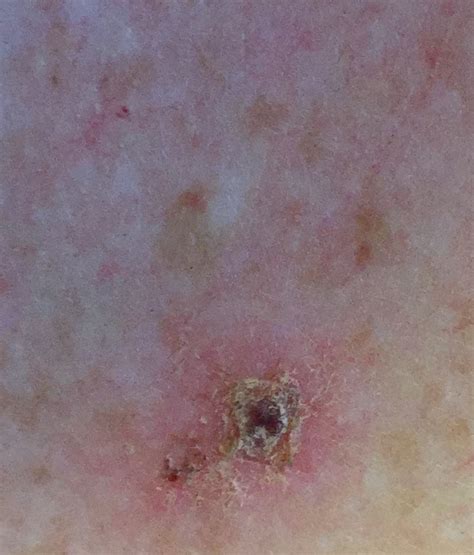 Morgellons Disease Pictures And Story Timesocket