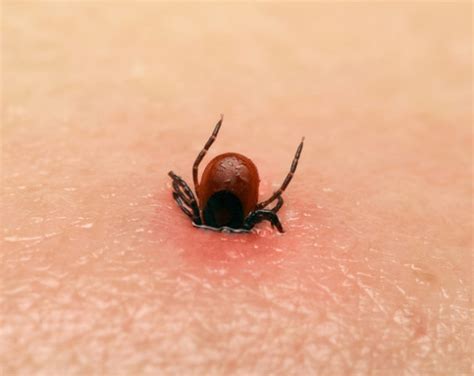 Tick Bite Tale From The Er Doctor Theres A Seed Attached To Me
