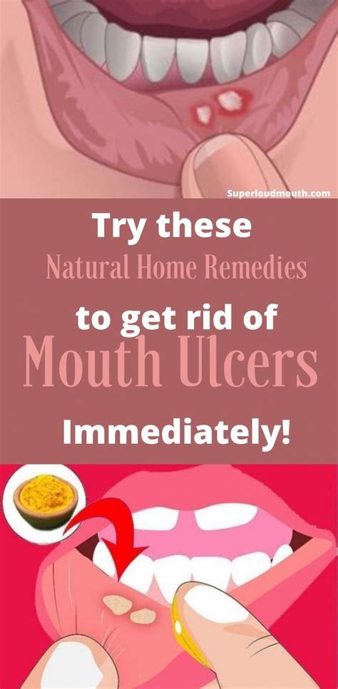 31 Home Remedies To Get Rid Of Mouth Ulcers Mouth Sores In 2020