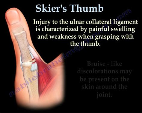 Skiers Thumb Gamekeepers Thumb Everything You Need To Know Dr