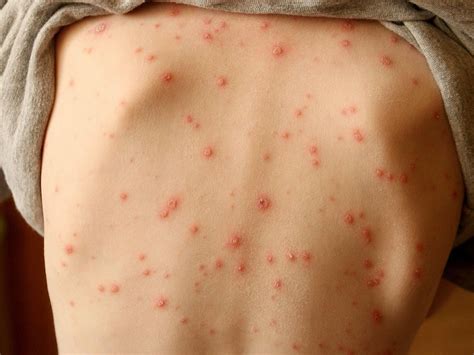 Skin Rash Should Be Considered Key Symptom Of Coronavirus Say