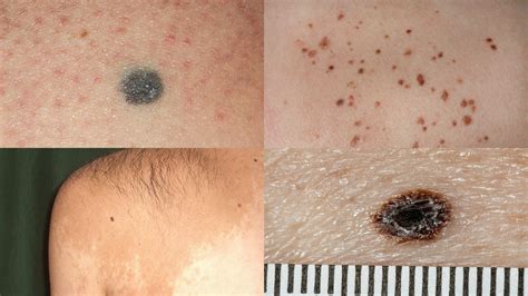 Skin Moles Types Causes And Skin Care Vlrengbr