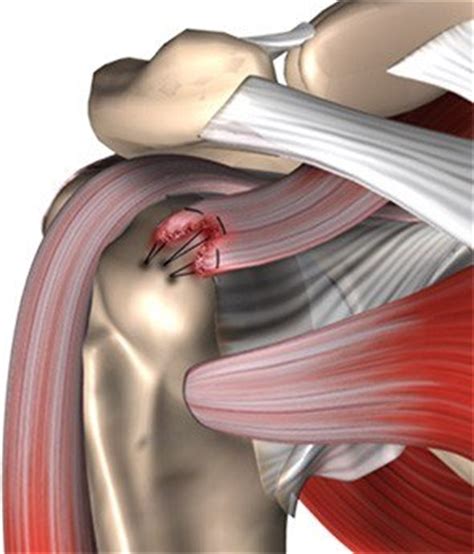 You don't want to do the physiotherapy program required after surgery. Rotator Cuff Repair Virginia Beach, VA | Norfolk ...