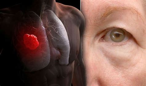 Lung Cancer Symptoms Signs Of A Tumour Include Having Droopy Eyelids