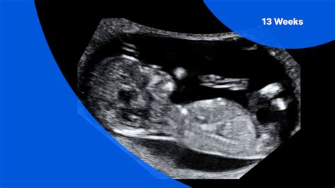 13 Weeks Pregnant Ultrasound Pockethealth