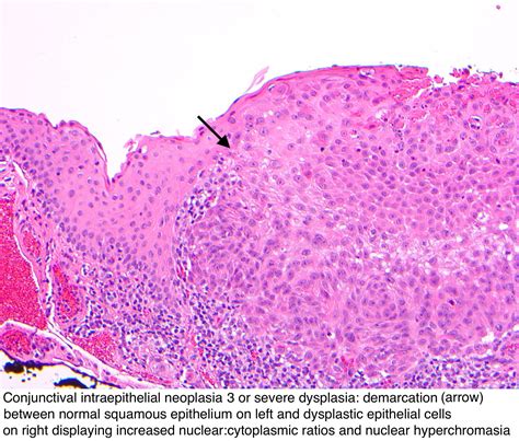 Pathology Outlines Conjunctival Intraepithelial Neoplasia