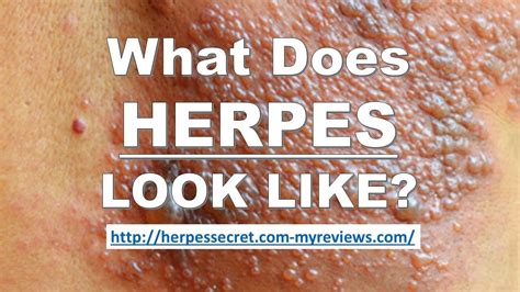 What Does Genital Herpes Look Like When It First Appears Youtube