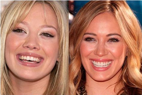 Hilary Duff Celebs Who Owe Their Smiles To Cosmetic Dentistry