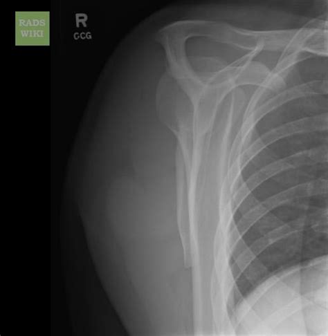 Because it moves in several directions, your the most common variety is a forward (anterior) dislocation. Shoulder dislocation x ray - wikidoc